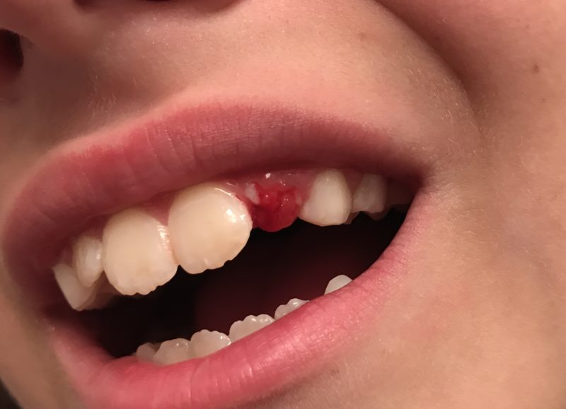 kids loose tooth